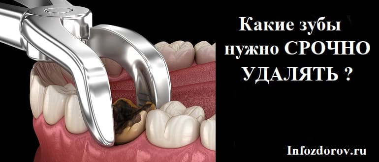 В каких случаях удаляют зуб