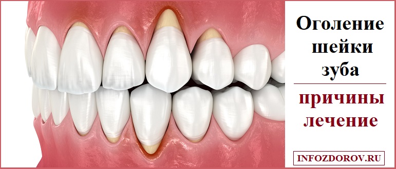 Оголение шейки зуба - лечение