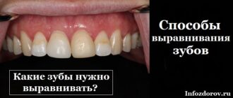 Способы выравнивания зубов