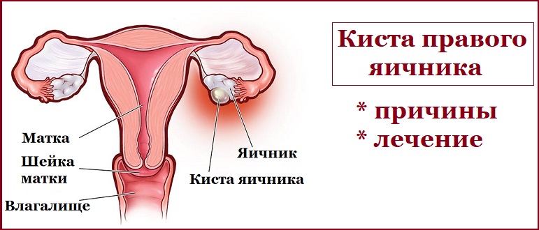 Киста правого яичника